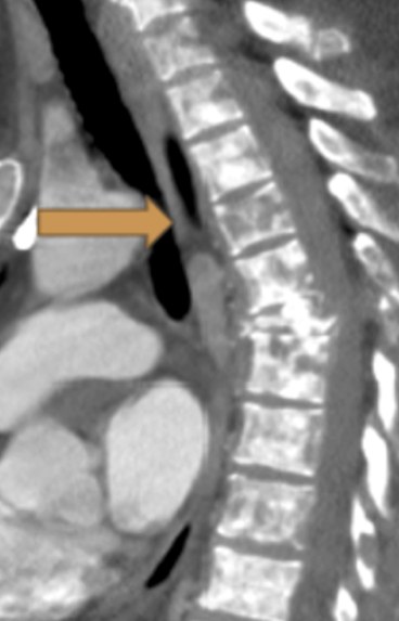 Sagittal CT with an arrow on the T4 vertebra, flagged as high risk